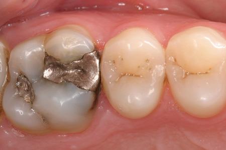 CEREC Inlay Margins | CADStar