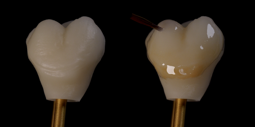 e.max Implant crown with MiYO 850